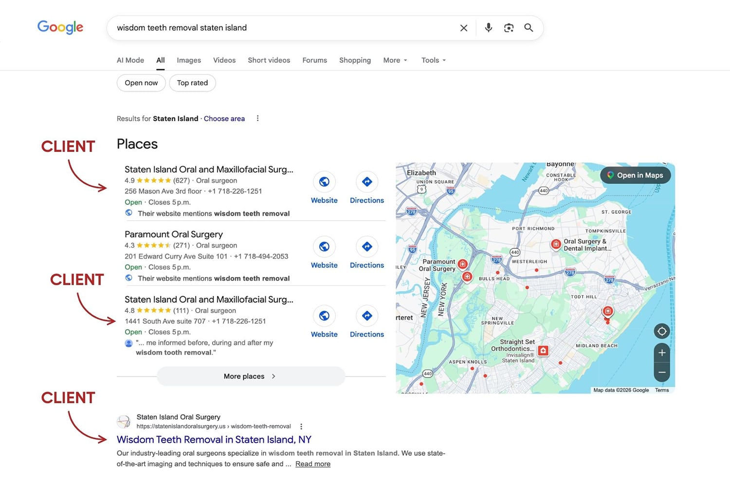 Screenshot of SIOMS ranking #1 on Google in the map pack and organic results for the query "wisdom teeth removal staten island"